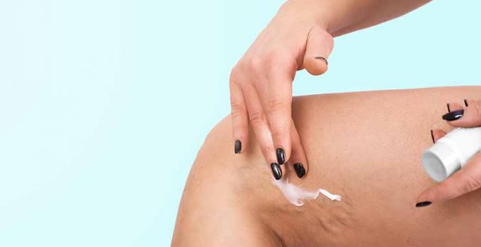 Tratamiento para la celulitis infecciosa - Apréndete