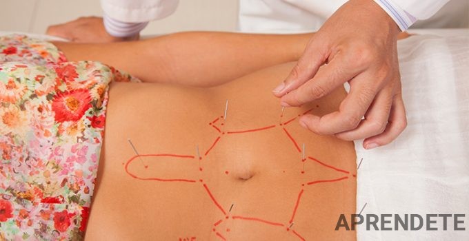 acupuntura-para-adelgazar-1