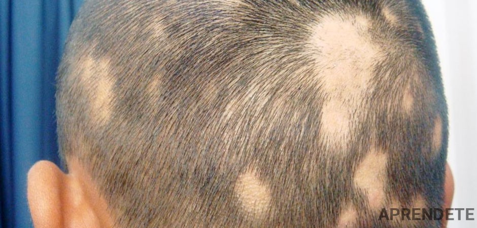 Cómo tratar la alopecia areata en 7 pasos - Apréndete