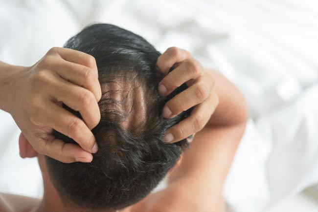 ¿Qué es la alopecia areata y cuáles son sus causas? - Apréndete