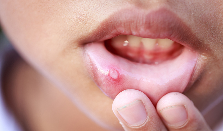 5 remedios caseros para el herpes labial - Apréndete