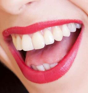 Mujer con amplia sonrisa, labios rojos y dientes blancos y alineados.
