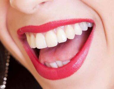 Mujer con amplia sonrisa, labios rojos y dientes blancos y alineados.